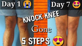 Fix Knock Knee in 7 days  knock knee problem solution [upl. by Nelav754]