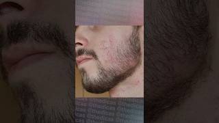 1 ANO E 6 MESES usando Minoxidil minoxidil foligain evolução minoxidil barba barbearia [upl. by Conrado789]