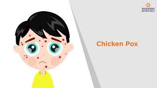 Chicken Pox Symptoms Causes Prevention and Treatment  Yashoda Hospitals [upl. by Nohtanhoj]