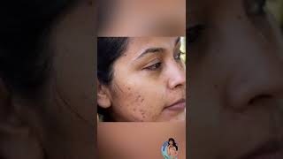 kojiglo gold skin lightening cream in tamil [upl. by Nadirehs559]