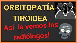 ORBITOPATÍA TIROIDEA 👀Hallazgos radiológicos [upl. by Eiznyl]