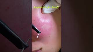 Cosmetic Acupuncture for Beautification health acupuncture viralvideo [upl. by Rramaj687]