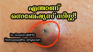 Sebaceous cyst malayalamdoctor Drroshinhomoeopathytreatment [upl. by Rozele]