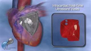 Real time 3D Image Guidance using the RTIIdeveloped LVI Intracardiac Catheter [upl. by Patsis347]