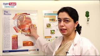 Uveitis and its treatment by Dr Abhilasha Baharani Neoretina Eyecare Institute Hyderabad [upl. by Quinton]