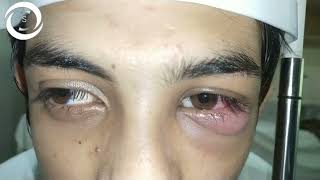 Acute Stye with Preseptal Cellulitis [upl. by Neenaej]