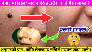 laser mole removal price in nepal  scars removal price in nepal  nepal skin hospital  kothi hatau [upl. by Patrica]