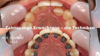 Zahnspange Erwachsene  die Techniken  mit update 2015 [upl. by Attenej]