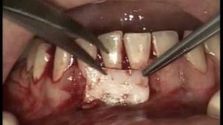 Implants Dentaires  Greffe gingivale libre [upl. by Leirad557]