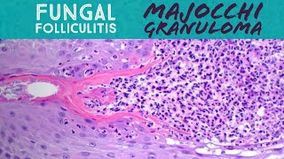 Majocchi granuloma fungal folliculitis by dermatophyte tinea “ringworm” fungus dermatology [upl. by Athey444]