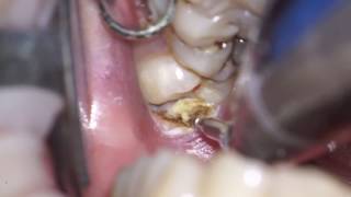 operculectomy of mn 3dr molar [upl. by Aenea]