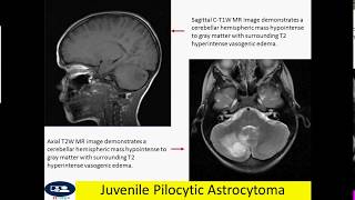 Juvenile Pilocytic Astrocytoma [upl. by Frants]