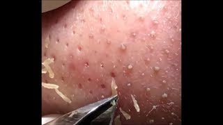 角栓 除去 blackheads removal 080 [upl. by Gschu]