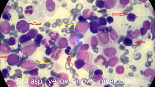 Acute Erythroblastic Leukemia M6 a [upl. by Kapor]