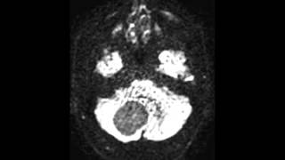 Hemangioblastoma [upl. by Yllaw]