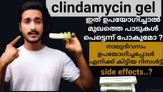 clindamycin gel malayalam  acne remove clindamycin gel  side effects  4 days  remove pimple [upl. by Terriss]