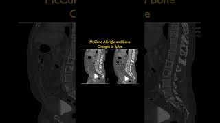 McCune Albright and Bone Changes in Spine [upl. by Novart]