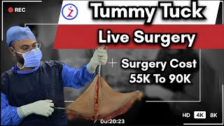 Tummy Tuck Surgery In Chennai  Tummy Tuck Surgery Cost In Chennai  Zenith Clinic [upl. by Aerdnwahs]