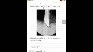 Achalasia cardia surgeryneetpg [upl. by Sllew]