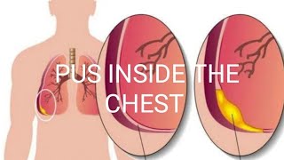 PUS INSIDE THE CHESTEMPYEMA [upl. by Oech]