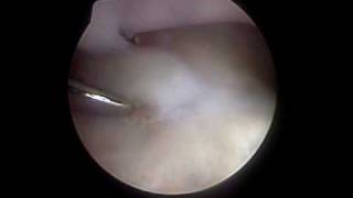 Fragmented medial coronoid process [upl. by Otxilac398]