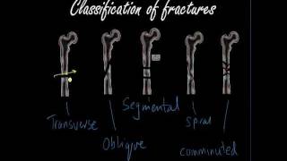 Classifying and presenting Fractures  Orthopaedics for Medical Students  Finals [upl. by Kieger262]