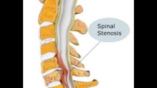 Estenosis Espinal [upl. by Leihcar]