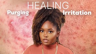 PURGING OR IRRITATION  Esthetician Explains How to Identify and Treat Both Conditions [upl. by Mcdade992]