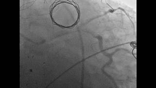 Vol3 Issue 4  Video 5 Continuous Assessment of a Stented Coronary Artery [upl. by Adnahsat]