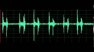 Pulmonary Associated Heart Sounds Tricuspid Regurgitation [upl. by Ellenet]