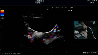 Part 2 Abdominal and pelvic Ultrasound prob handling by Dr imran waheed sb [upl. by Areivax]