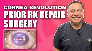 Corneal RK Radial Keratotomy Repair with Topographic Guided Ablation [upl. by Dnalor]