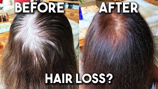 Thinning Hair New Technology  HairMax LaserBand 82 to Regrow Hair [upl. by Malinda217]