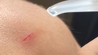 Putting hand sanitizer in a cut [upl. by Eran630]