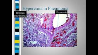 Pathology of congestion Vs Hyperemia [upl. by Mcclish967]