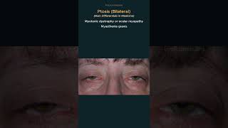 Ptosis Causes of bilateral ptosis osce practicalmedicine diagnosis [upl. by Engelbert]