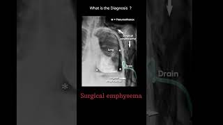 Surgical emphysema 200 chest Xray tubes Quiz radiologychannel007 [upl. by Craddock]