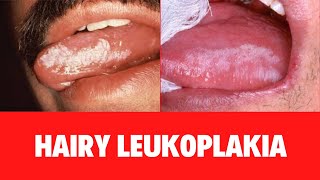 WHAT IS HAIRY LEUKOPLAKIA Oral Hairy Leukoplakia Symptoms Causes Diagnosis Treatment [upl. by Iahc]