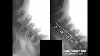 Improvement of cervical anterolisthesis DMX review with Ross Hauser MD [upl. by Jeni]