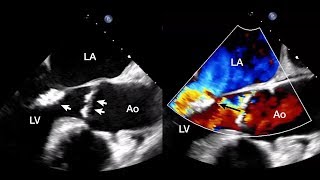 Aortic and Mitral Valve Endocarditis Due to Austin Flint Phenomenon [upl. by Ettedanreb965]