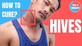 How to treat Hives Urticaria  Doctor Explains [upl. by Meggie]