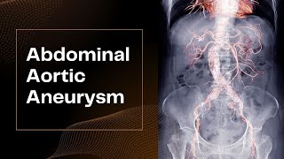 Abdominal Aortic Aneurysm [upl. by Goerke]