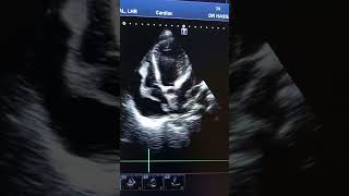 pericardial effusion with cardiac tamponadeecho fcps [upl. by Bowen]