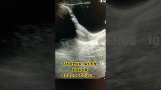 Pelvic ultrasound ultrasound shortfeed uterus medical pelvic pelvis ytviral study abdomen [upl. by Atilahs]