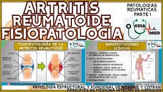 ARTRITIS REUMATOIDE FISIOPATOLOGÍA  GuiaMed [upl. by Huba]