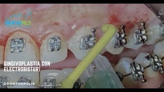 Gingivoplastia Con ElectroBisturí [upl. by Uokes]