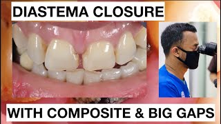 Step by Step Diastema Closure Composite with Big Gaps  General Dentist Griya RR [upl. by Naitsirhk590]