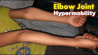 Hypermobile Elbows  Hyperextension of Elbow Joints [upl. by Letnohc81]