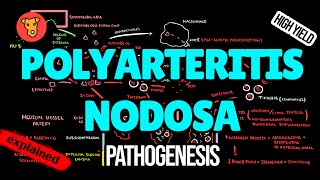 POLYARTERITIS NODOSA Pathogenesis Mechanism of Clinical symptoms Treatment [upl. by Haet]