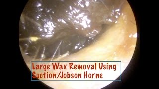 Large amount of ear wax removed with suction and jobson Horne  Ep 06 [upl. by Eigna]